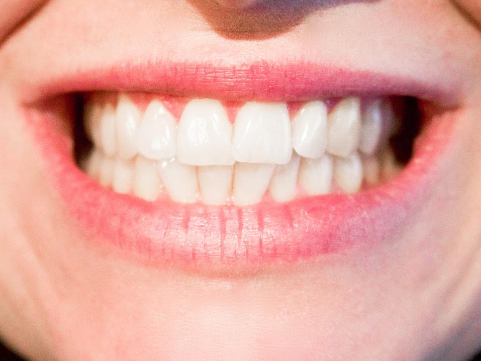 Fun Fact #1 – Der Zahnschmelz